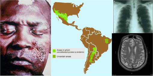 Coccidiomycosisimgs