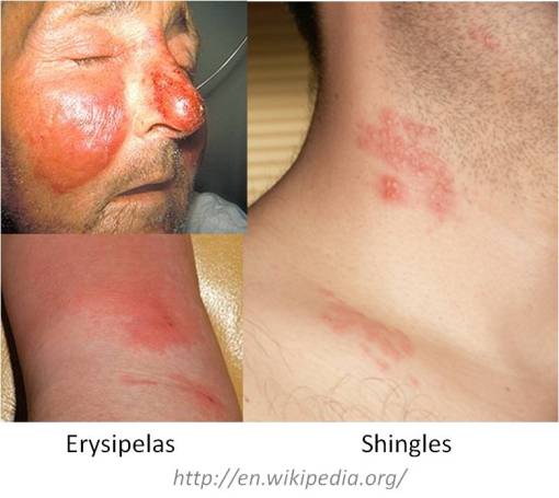 ErysipelasShingles