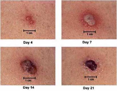 ThePoxVariousStages_