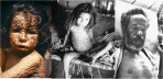 smallpox_3types