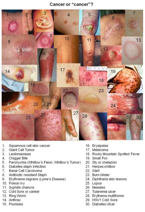 CancerorCanker_30imgs_Answers_HorizList