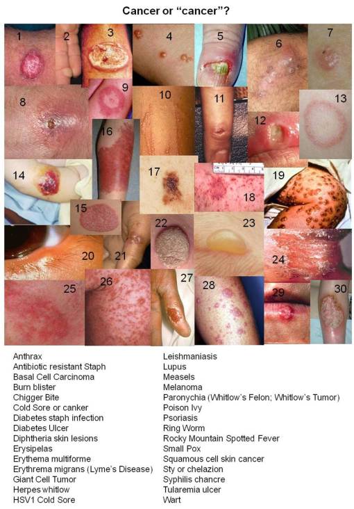 CancerorCanker_30imgs_HoriztlList