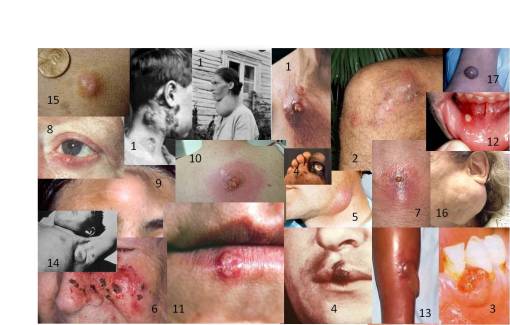 cancerstumorsabscessescankerserysipelasbuboes