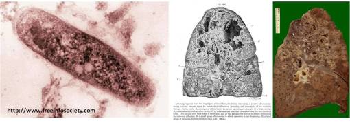 Bowditch_Tuberculosis
