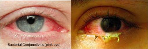 bacterialmembranousconjunctivitis