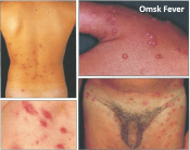 4RussianOmskFeverCases
