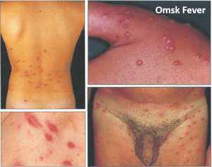 4RussianOmskFeverCases