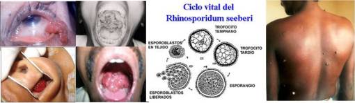 Rhinosporidumseeberimedimgs