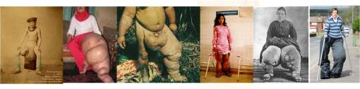 Elephantiasis2