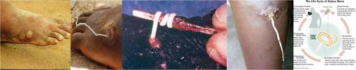guineaworm