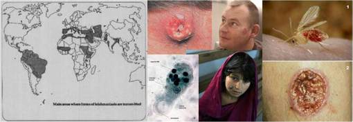 Leishmaniasis