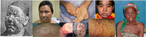 Leprosy(3forms-TB,viral,bacterial)