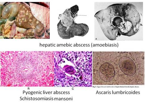 LiverAbscess_twoforms