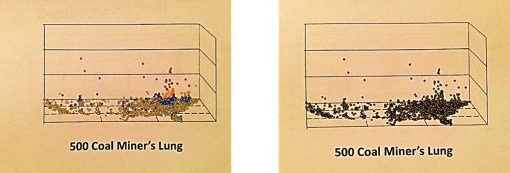CoalMinersLung_2types_Salmon