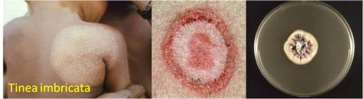 Othersp_TineaImbricata