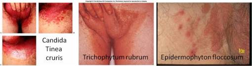 TrichophytonEpidermophytonCandida