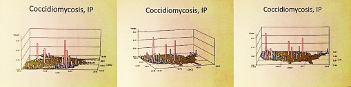 Coccidiomycosis_3ips