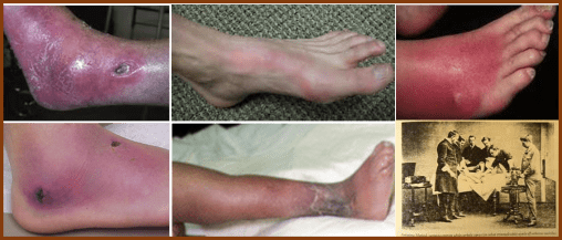Erysipelas_Wounds