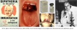 Diphtheria