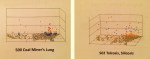 Survey_CoalMinersLung