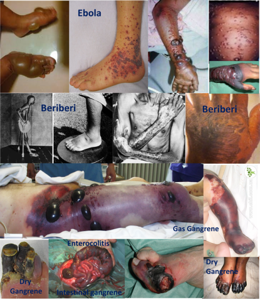 Ebola versus Beri Beri vs. various sorts of Gangrene