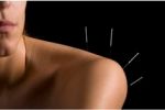 acupuncture