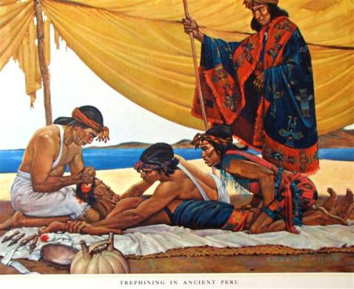 History of Medicine Trephining in Ancient Peru (Small)
